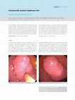 Research paper thumbnail of Asymptomatic duodenal duplication cyst