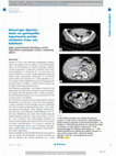 Research paper thumbnail of Hémorragie digestive haute sur gastropathie hypertensive portale révélatrice d’une rate baladeuse