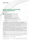 Research paper thumbnail of Augmentation of Pedicle Screws Using Bone Grafting in Patients with Spinal Osteoporosis