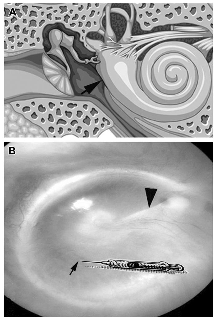 (PDF) Intratympanic steroid injection for inner ear disease