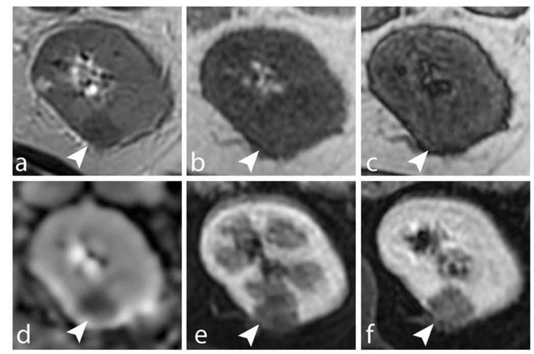 (PDF) Imaging protocols for renal multiparametric MRI and MR urography ...