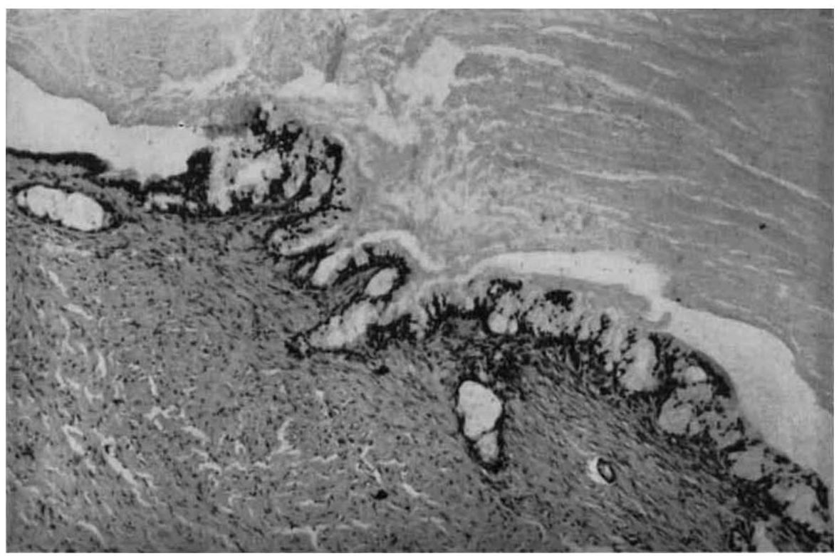 (PDF) Mucoepidermoid Carcinoma of the Parotid Gland
