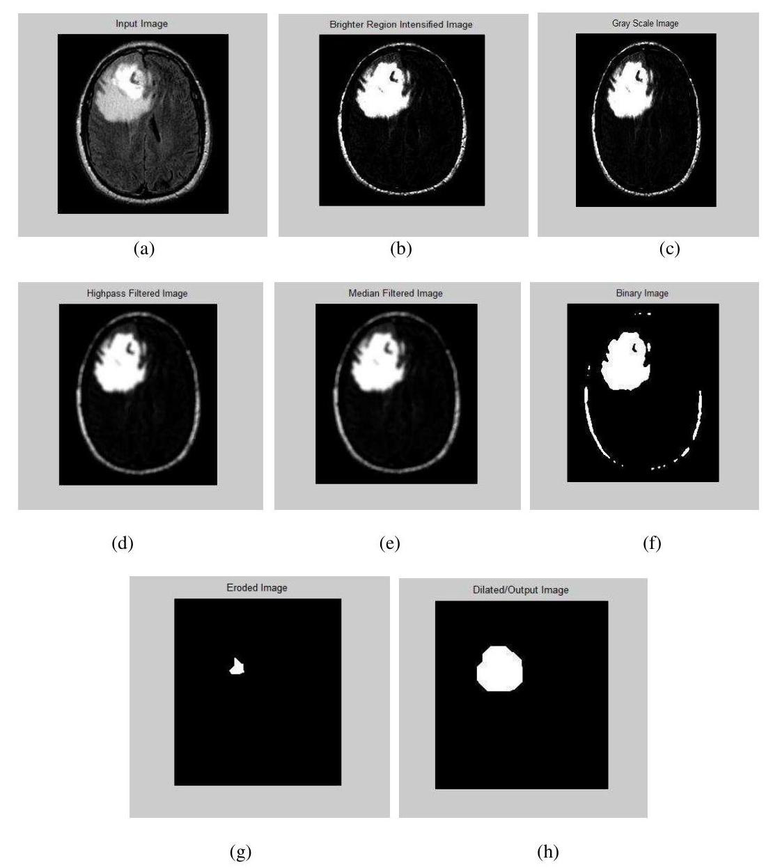 (PDF) DESIGN AND DEVELOPMENT OF A BRAIN TUMOR DETECTION SYSTEM FROM THE ...