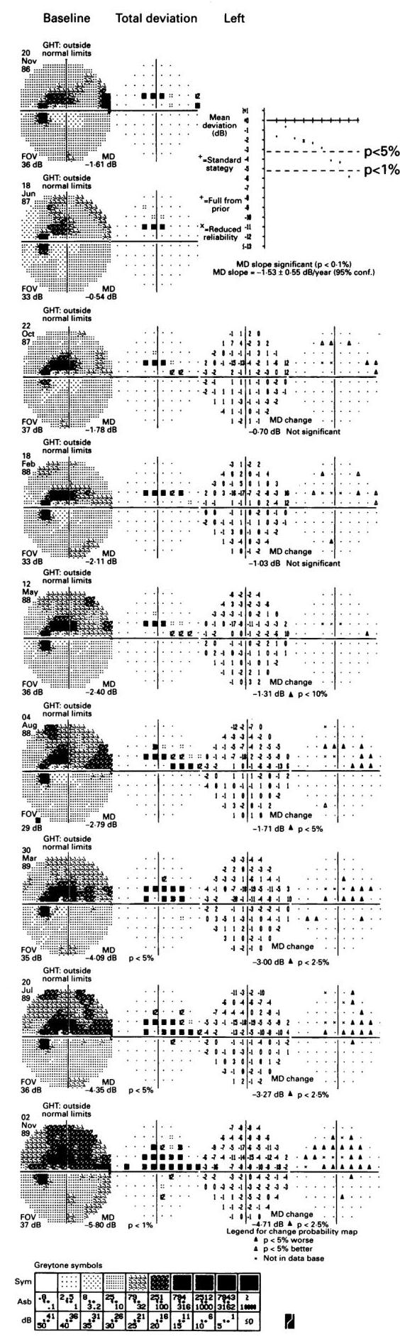 (PDF) Analysis of visual field progression in glaucoma