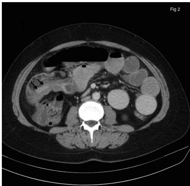Intestinal Interception (PDF) Adult intestinal intussusception — A report of 2 cases and ...