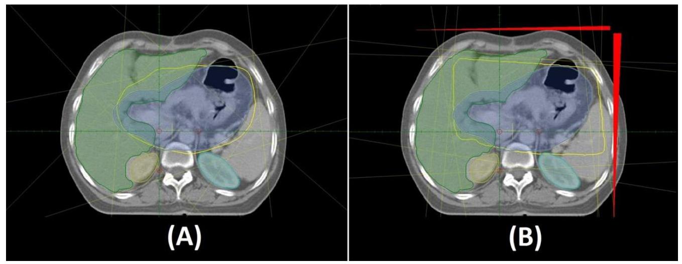 (PDF) Dosimetric comparison of 3D-conformal and IMRT radiotherapy ...